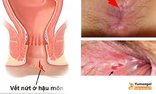 Phẫu thuật nứt kẽ hậu môn có đau không? Quy trình, chi phí, lưu ý