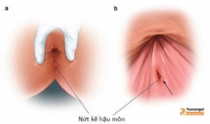 dấu hiệu nứt kẽ hậu môn