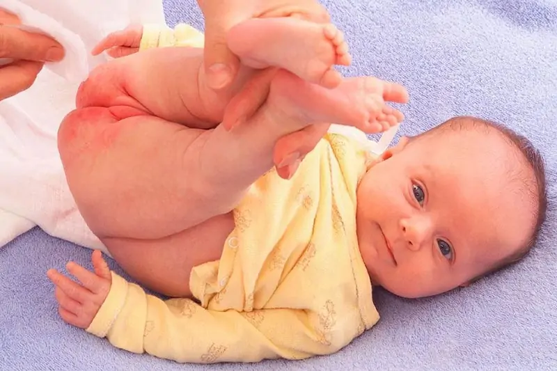Biểu hiện trẻ em bị nứt kẽ hậu môn