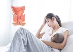 nứt kẽ hậu môn sau sinh