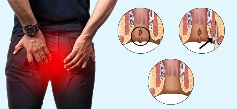 Phẫu thuật nứt kẽ hậu môn là như thế nào