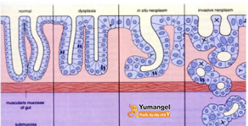 Triệu chứng chuyển sản ruột dạ dày