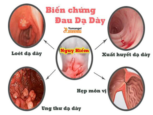 Biến chứng của đau dạ dày