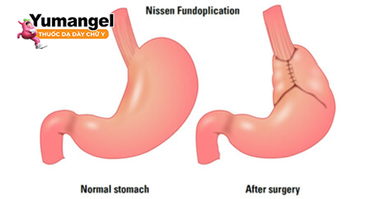 Phẫu thuật Nissen Fundoplication.