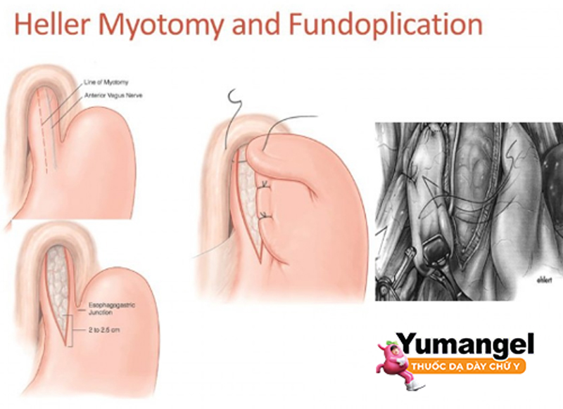 Phẫu thuật Heller myotomy