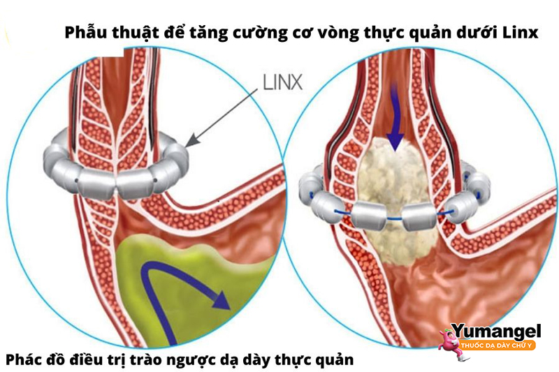 Phẫu thuật để tăng cường cơ vòng thực quản dưới Linx.