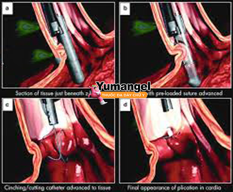 Phẫu thuật nội soi khâu tăng cường cơ vòng thực quản dưới.
