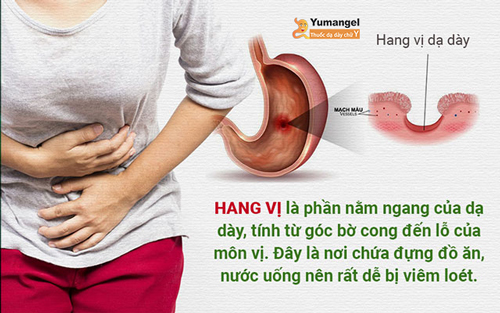 Nhiễm vi khuẩn HP là một nguyên nhân gây viêm hang vị