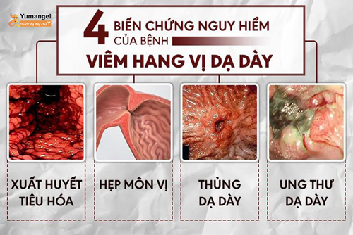 4 biến chứng nguy hiểm của viêm hang vị dạ dày