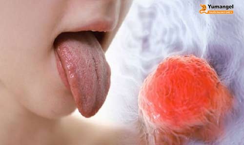 Trào ngược dạ dày có gây ảnh hưởng đến lưỡi