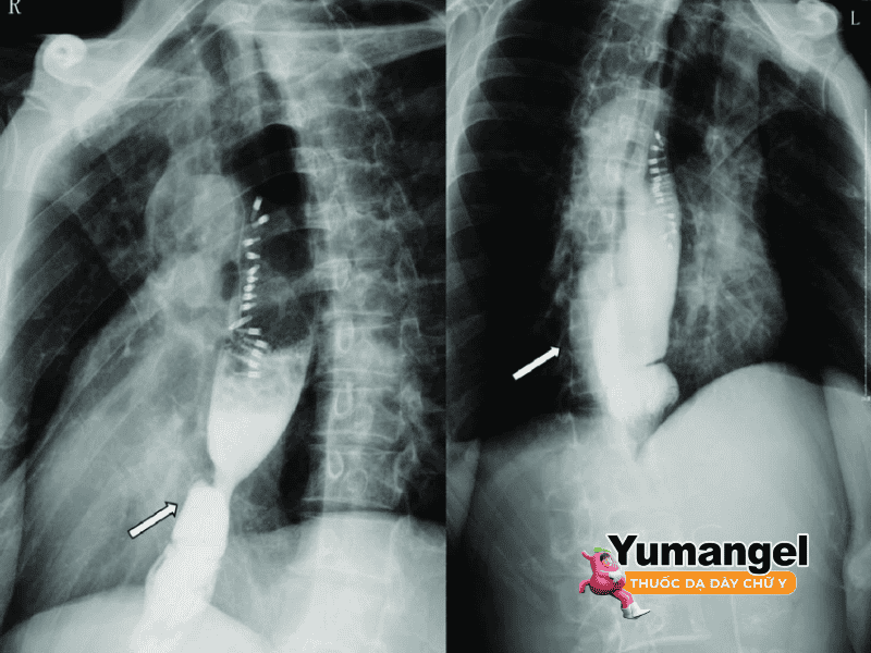 Chụp X- quang đường tiêu hóa