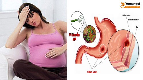 Đau dạ dày khi mang thai: A-Z thông tin mẹ cần biết