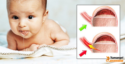 Một số trẻ nhỏ ngay từ khi sinh ra đã bị sa dạ dày, chức năng cơ thắt thực quản dưới kém gây trào ngược dạ dày thực quản.