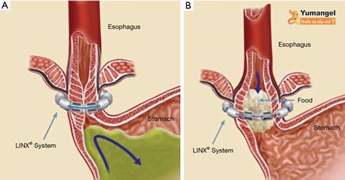 Phẫu thuật tăng cường cơ vòng thực quản dưới Linx