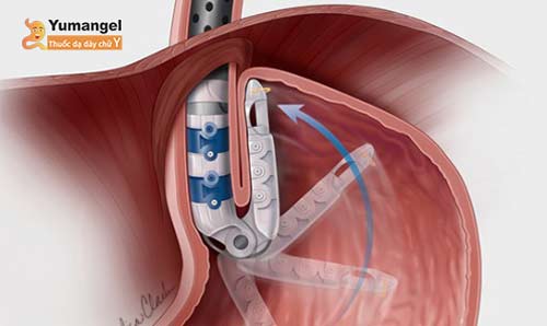 Phẫu thuật nội soi xuyên miệng hay phẫu thuật Transopless Fundoplication (TIF)