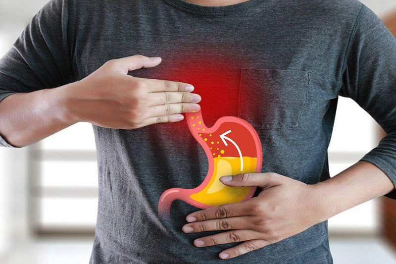 Viêm trào ngược dạ dày thực quản độ A