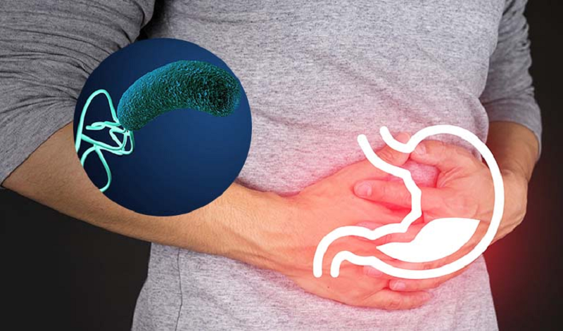 Viêm trào ngược dạ dày thực quản độ A