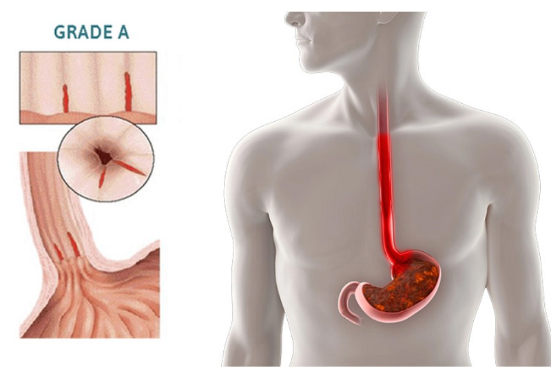 Viêm trào ngược dạ dày thực quản độ A