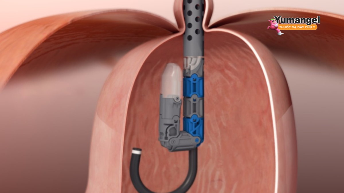 Phẫu thuật Nissen Fundoplication