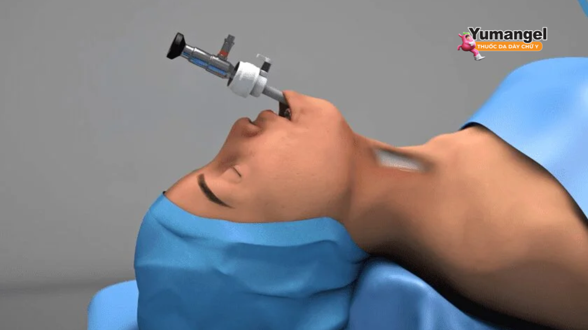 Một thiết bị EsophyX được đưa vào thực quản qua đường miệng