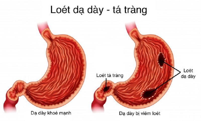 các bệnh về dạ dày