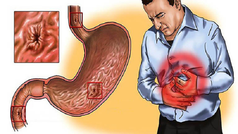 các bệnh về dạ dày