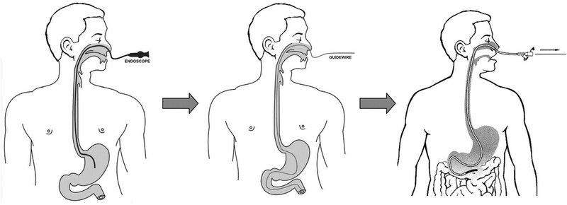 các bệnh về dạ dày