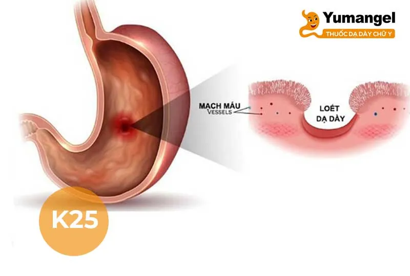 mã icd viêm loét dạ dày - k25