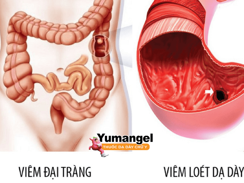 Đau đại tràng và đau dạ dày là 2 bệnh lý khác nhau nhưng có triệu chứng khá tương đồng