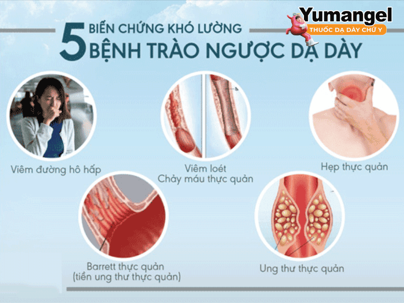 Một số biến chứng của bệnh trào ngược dạ dày thực quản K21