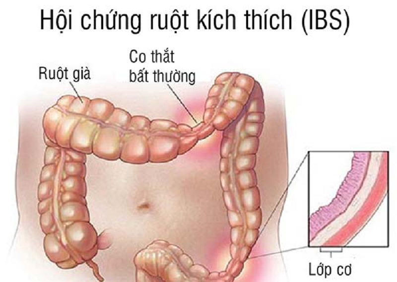 Hội chứng ruột kích thích là gì