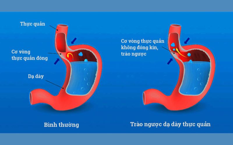 trao-nguoc-da-day-an-bo-1