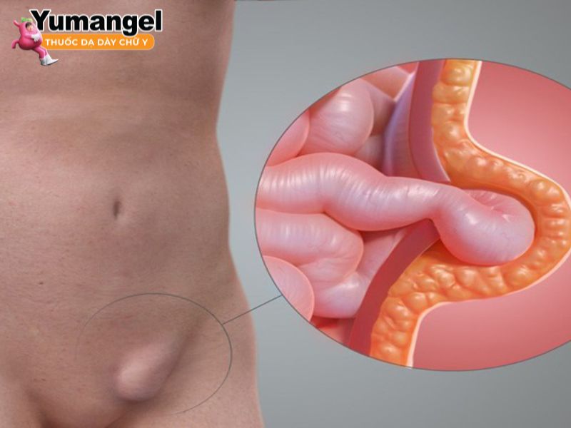 Đau bụng bên trái ngang rốn là tình trạng bị đau nhói và quặn thắt ở vùng bụng bên trái