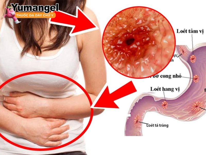 Viêm loét dạ dày gây đau bụng trên rốn