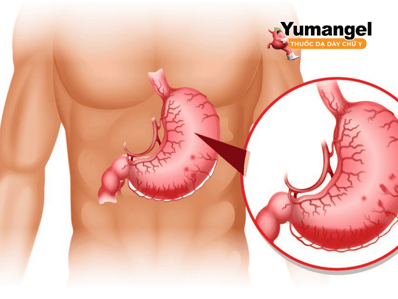 Nhận biết bệnh sa dạ dày cảm thấy khó chịu, đầy bụng, dạ dày căng tức.