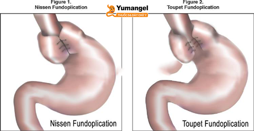 7+ thông tin cần biết về phẫu thuật Toupet chữa trào ngược dạ dày