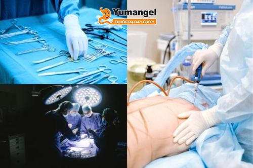 Hình ảnh mổ nội soi Toupet Fundoplication