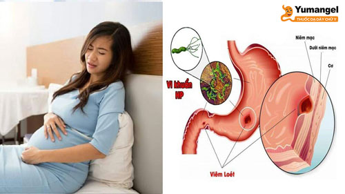 Ngoài nhiễm vi khuẩn HP, viêm loét dạ dày ở mẹ bầu cũng có thể do ảnh hưởng của hormone và các thay đổi sinh lý xảy ra trong thai kỳ.