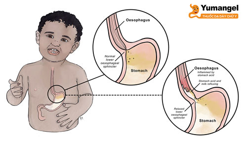 Trẻ 3 tuổi bị trào ngược dạ dày thực quản chủ yếu là do cơ thắt thực quản dưới yếu. 