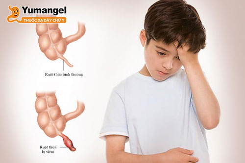 Trẻ bị đau bụng quanh rốn kèm buồn nôn cũng có thể là do bệnh viêm ruột thừa