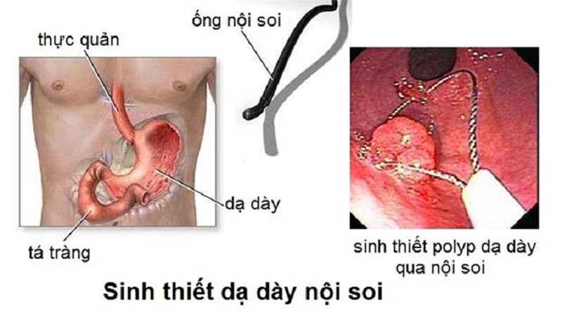 giá nội soi dạ dày có bảo hiểm y tế