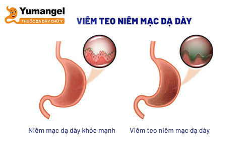 Nguyên nhân gây bệnh viêm teo niêm mạc dạ dày HP âm tính có thể là do hệ thống miễn dịch bị nhầm lẫn, cơ thể bị thiếu hụt vitamin B12…