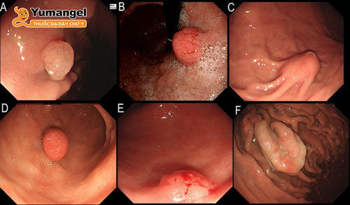 Polyp dạ dày là khối tế bào hình thành trên lớp lót bên trong dạ dày. 