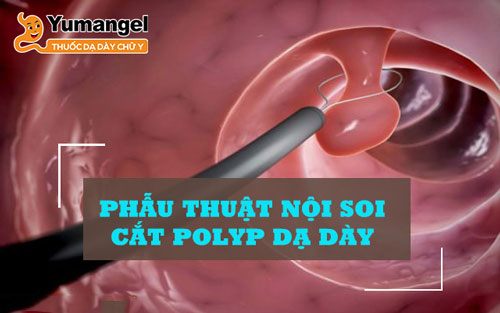 Phẫu thuật nội soi cắt polyp dạ dày 