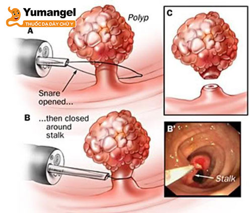 Tùy thuộc phương pháp cắt, kích thước và số lượng polyp dạ dày mà thời gian hồi phục sau khi cắt polyp dạ dày sẽ khác nhau, có thể từ 1-2 tuần hoặc lâu hơn.