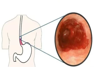 Cắt polyp thực quản có nguy hiểm không