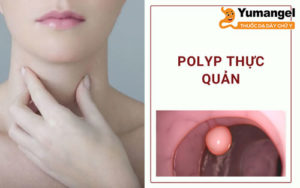 Hình ảnh polyp thực quản. 