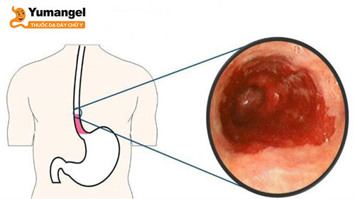 Cắt polyp thực quản có thể gây ra một số biến chứng hiếm gặp như chảy máu, nhiễm trùng, rách hoặc thủng thực quản… 