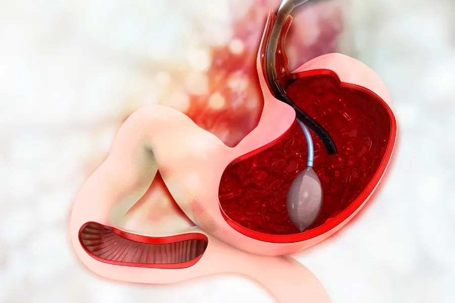 Sau cắt polyp dạ dày bao lâu thì được ăn?