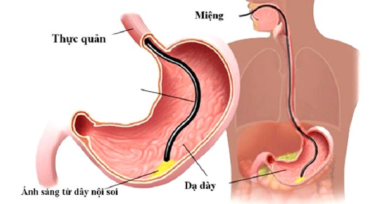 Nội soi dạ dày nhiều có hại không